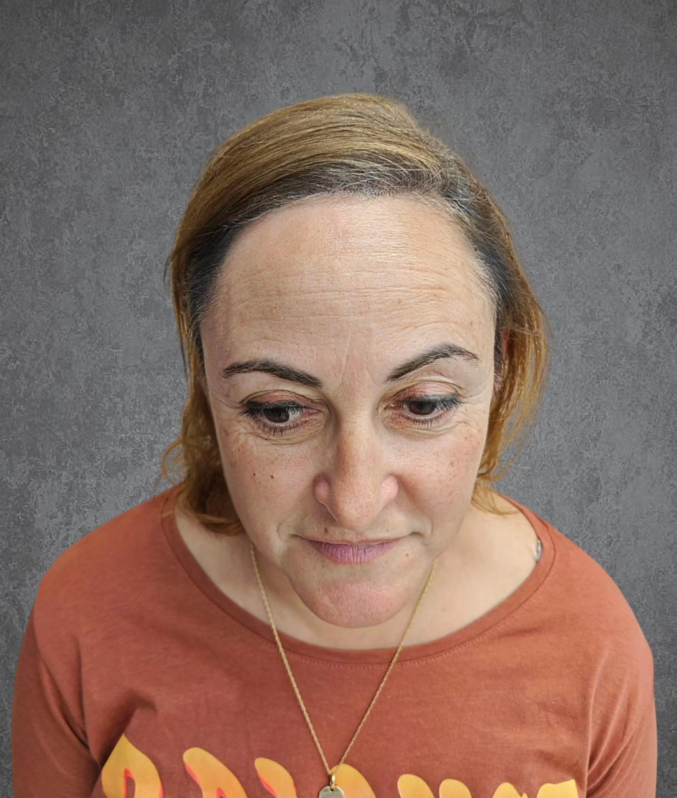 cabeza de hombre calvo antes y despues del tratamiento de micropigmentacion capilar