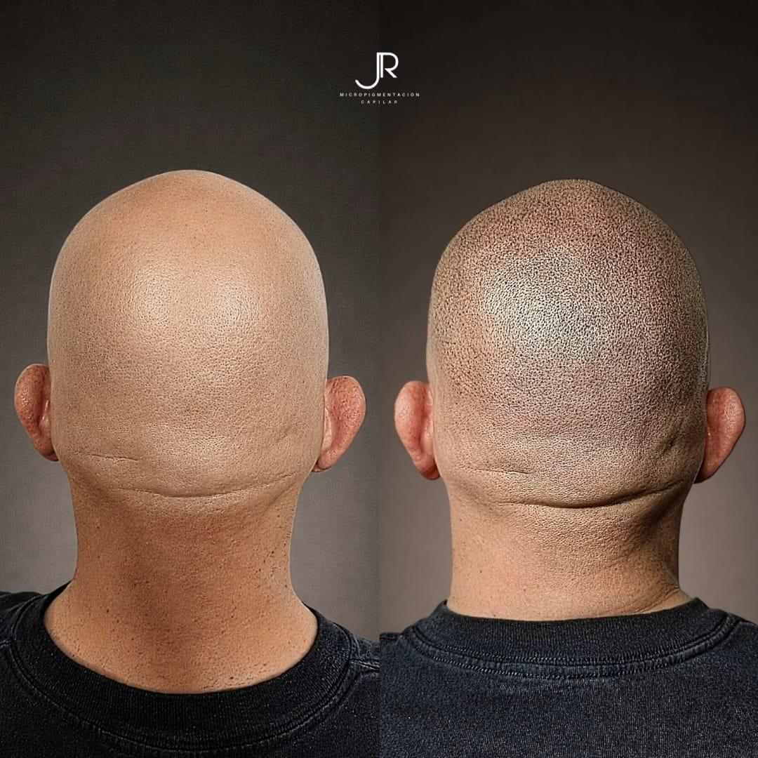 cabeza de hombre calvo antes y despues del tratamiento de micropigmentacion capilar